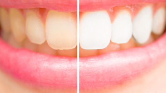 コーヒー飲んでても、輝く白い歯を保ちたい！！！【ドラッグストア】で購入出来るものから、【KUMAROMAで購入可能】なもの、【病院系】まで実践したものを一挙公開✨